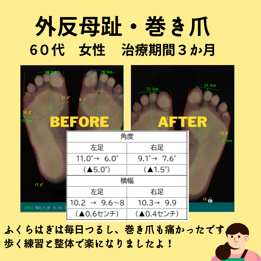 外反母趾