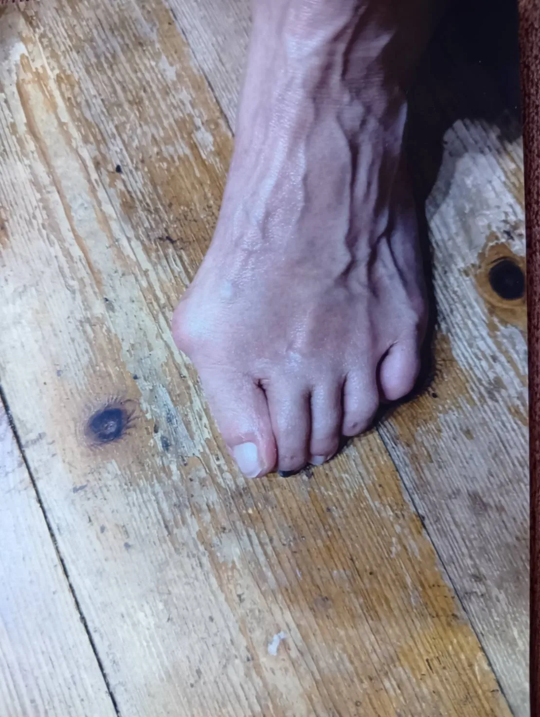 外反母趾