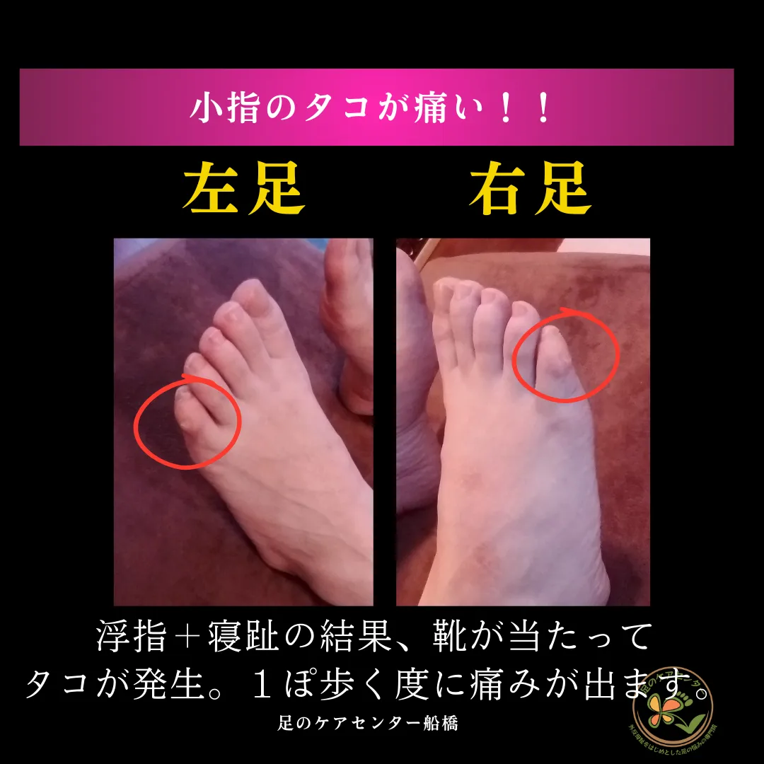 外反母趾