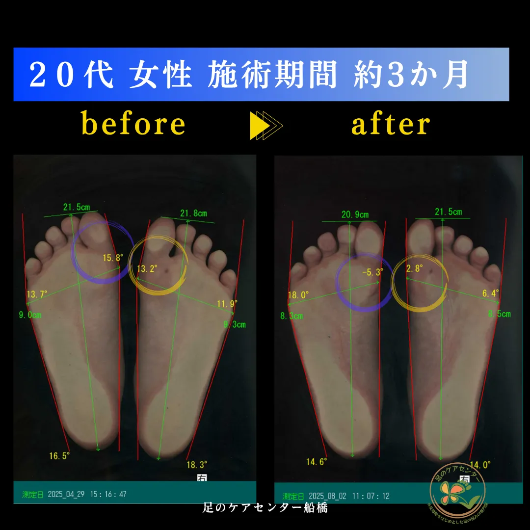 外反母趾
