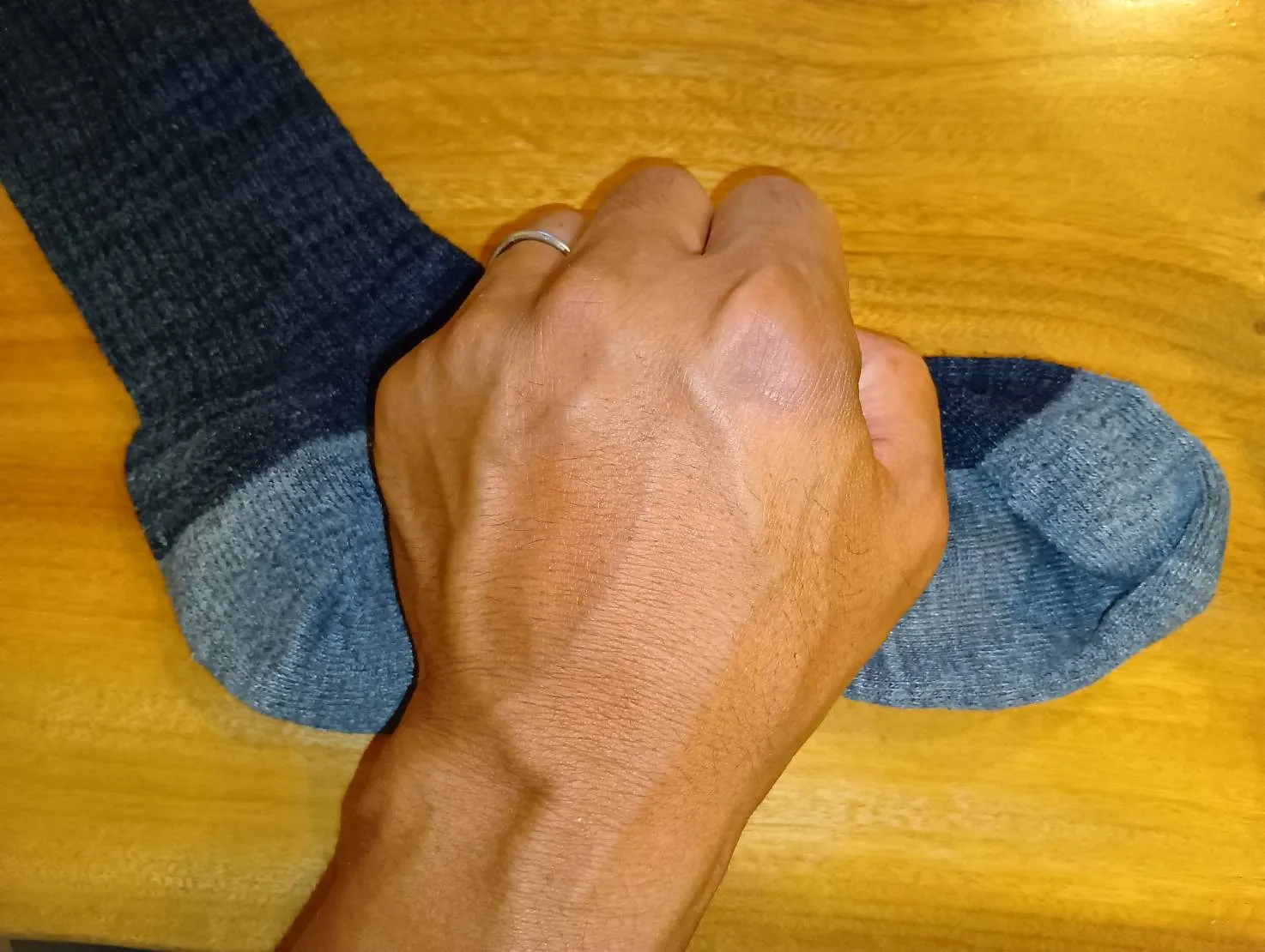 外反母趾
