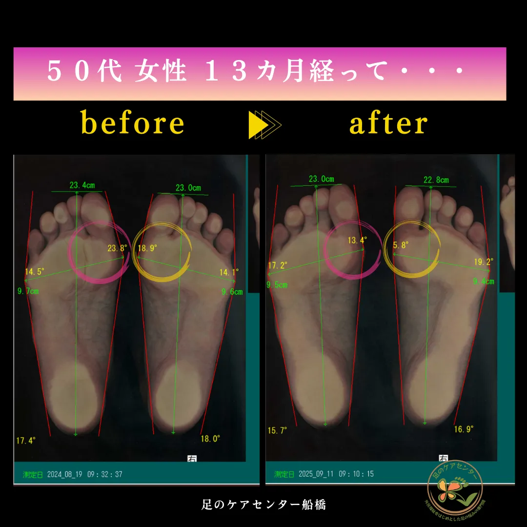 外反母趾