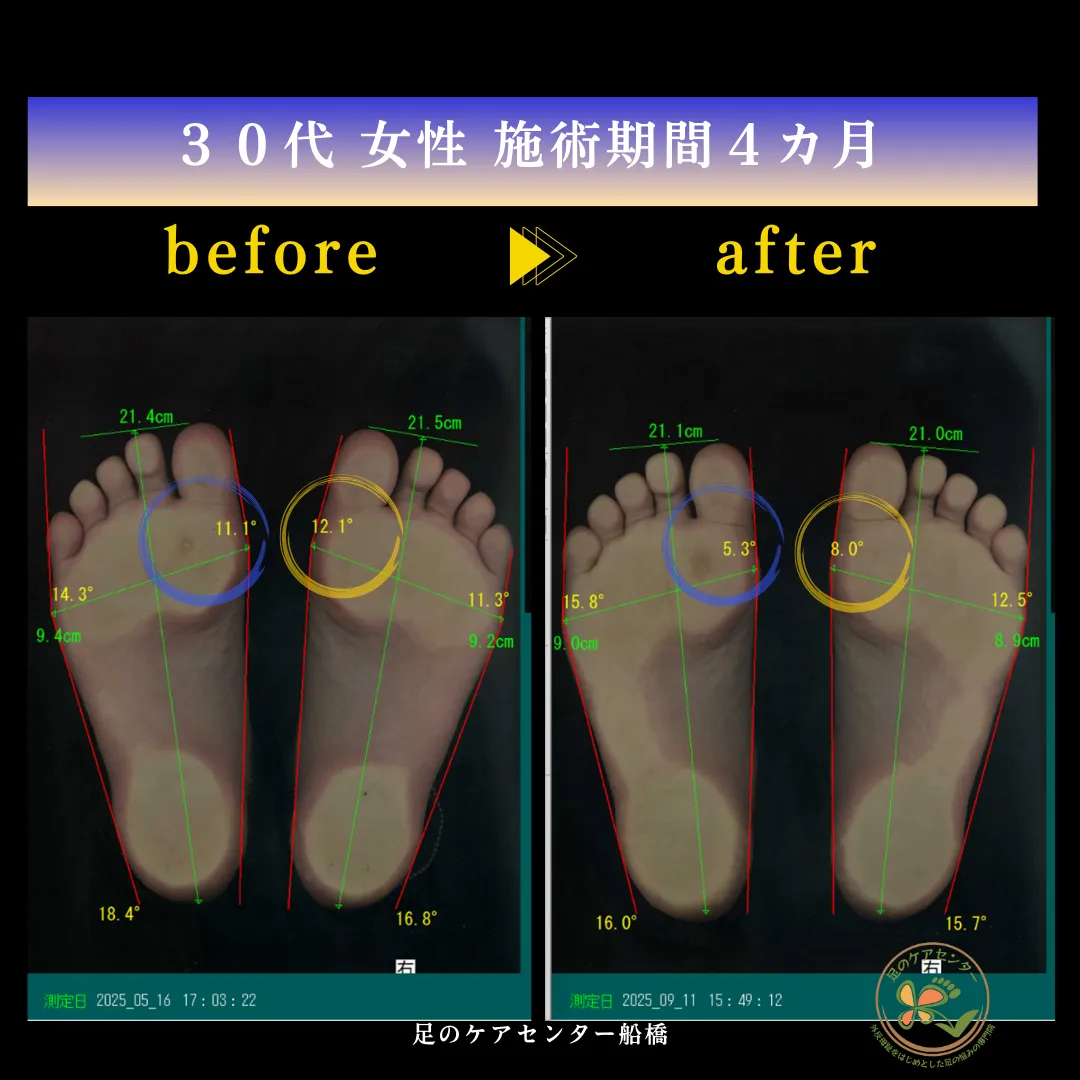 外反母趾