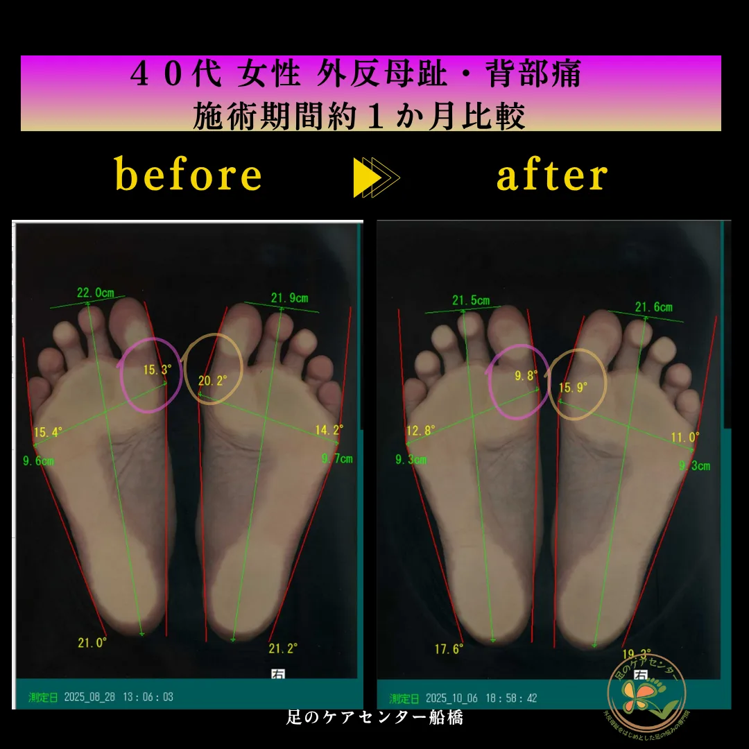 外反母趾