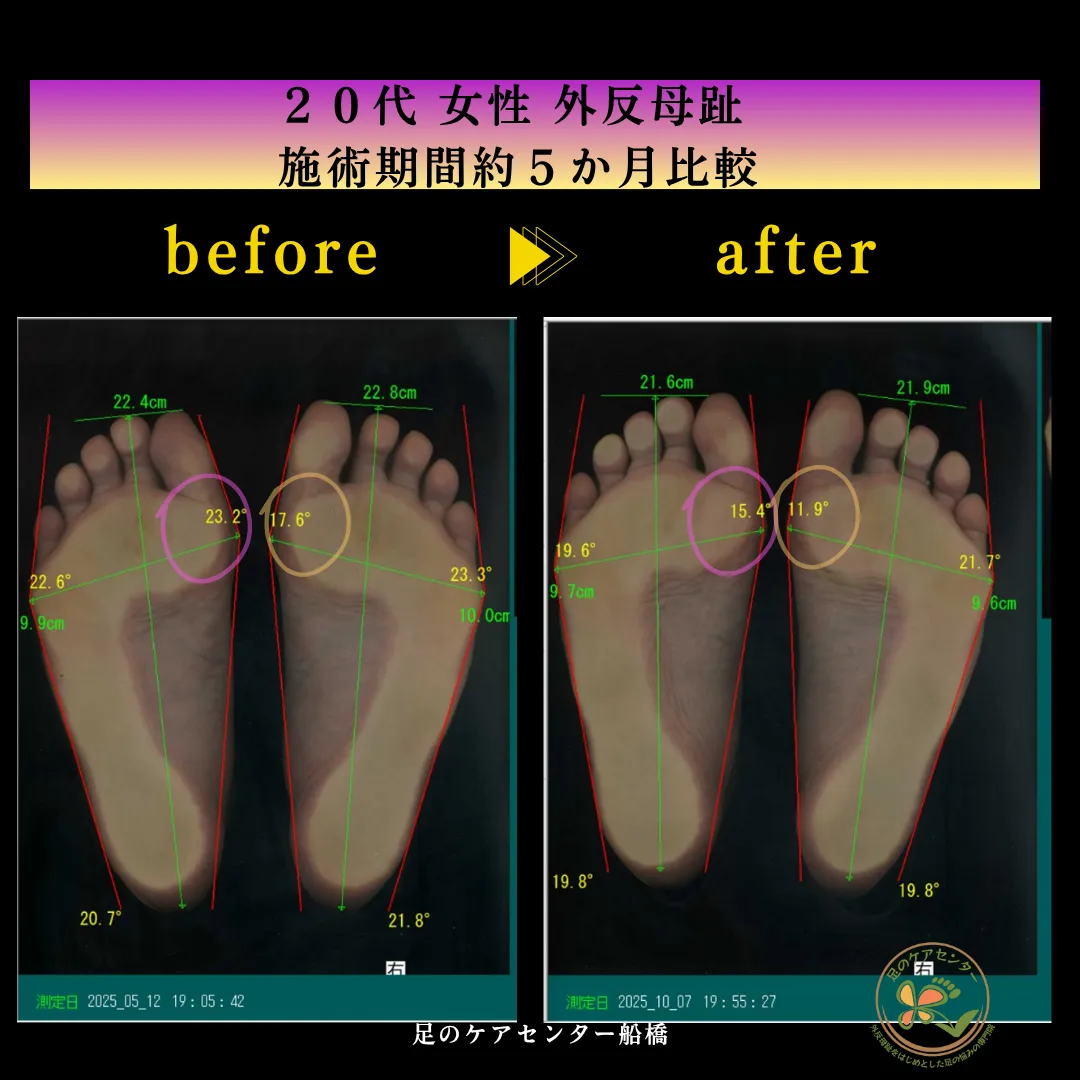 外反母趾