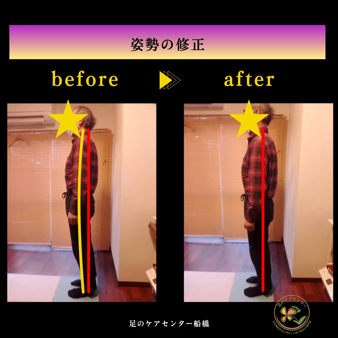 外反母趾
