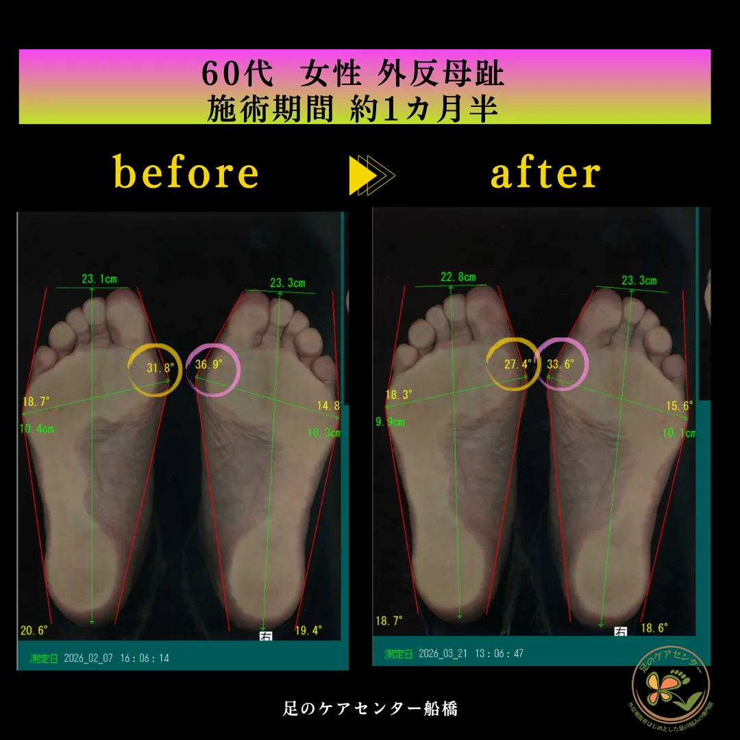 60代女性 外反母趾