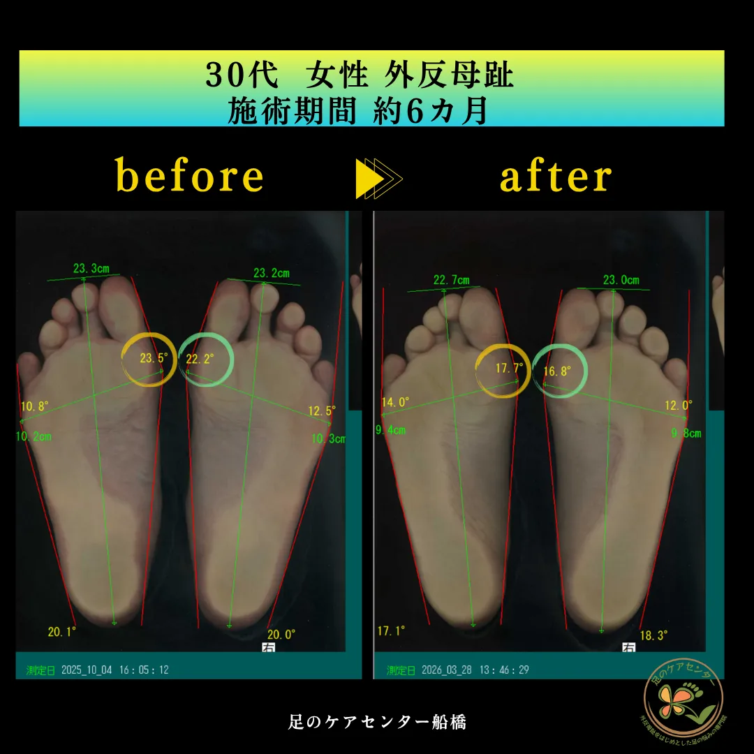 30代女性 外反母趾