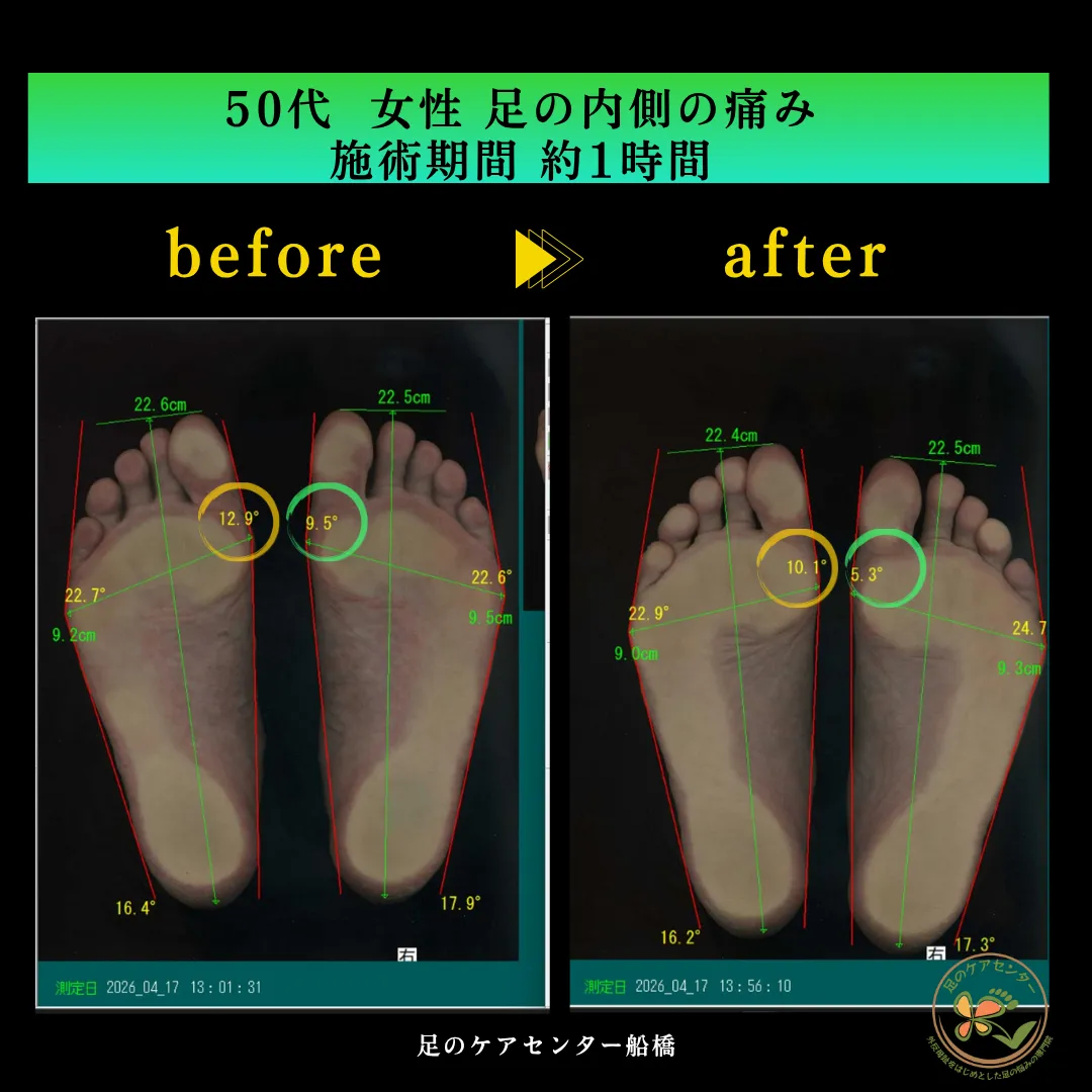 回内痛