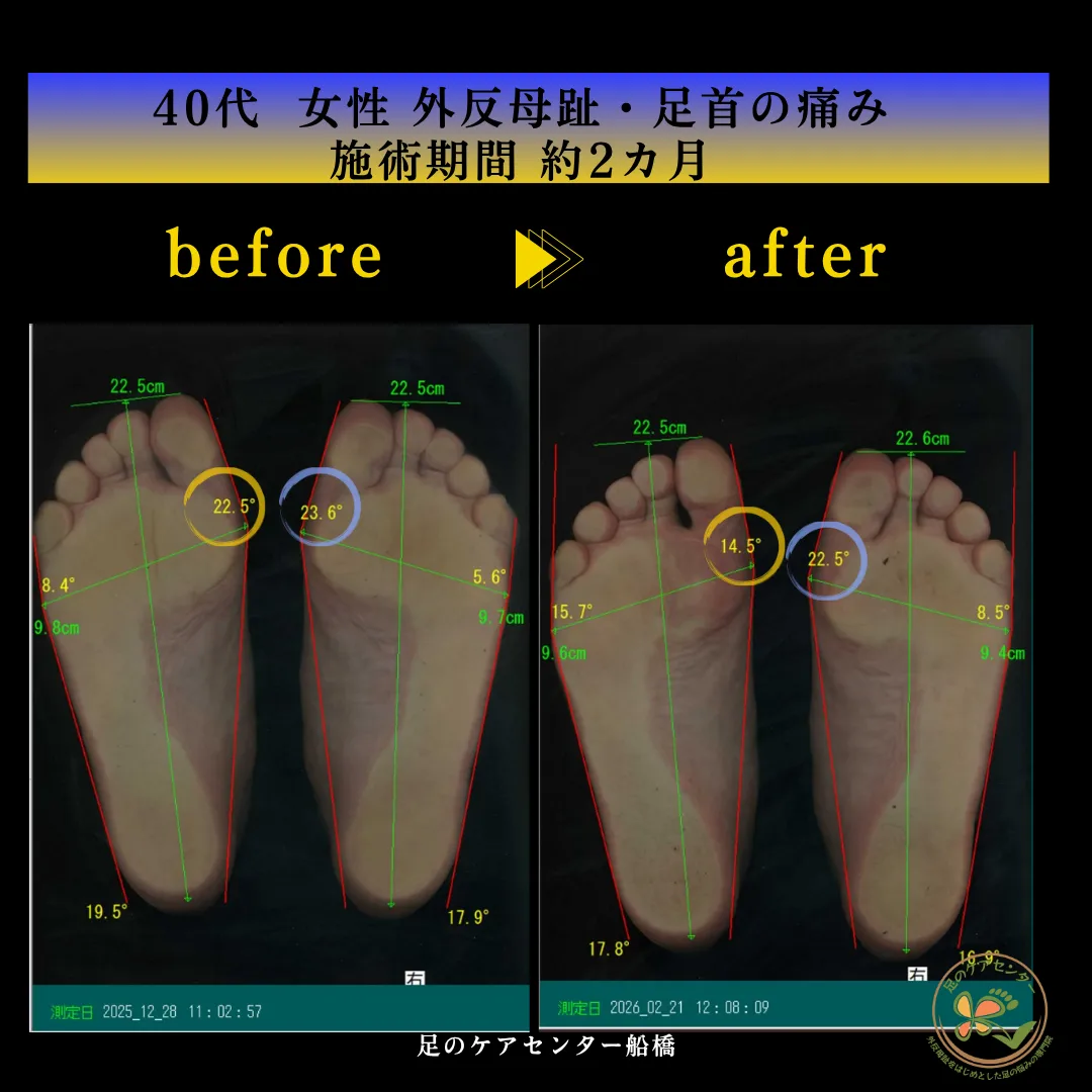 40代女性 外反母趾 回内足