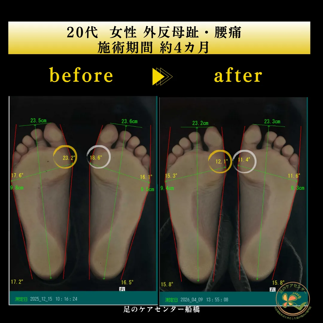 20代女性 ダンサー 外反母趾